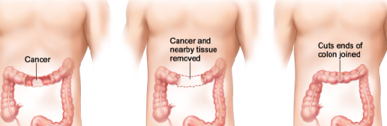 Early-Onset Colorectal Cancer