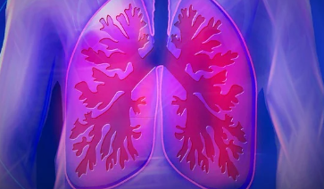  Lung cancer